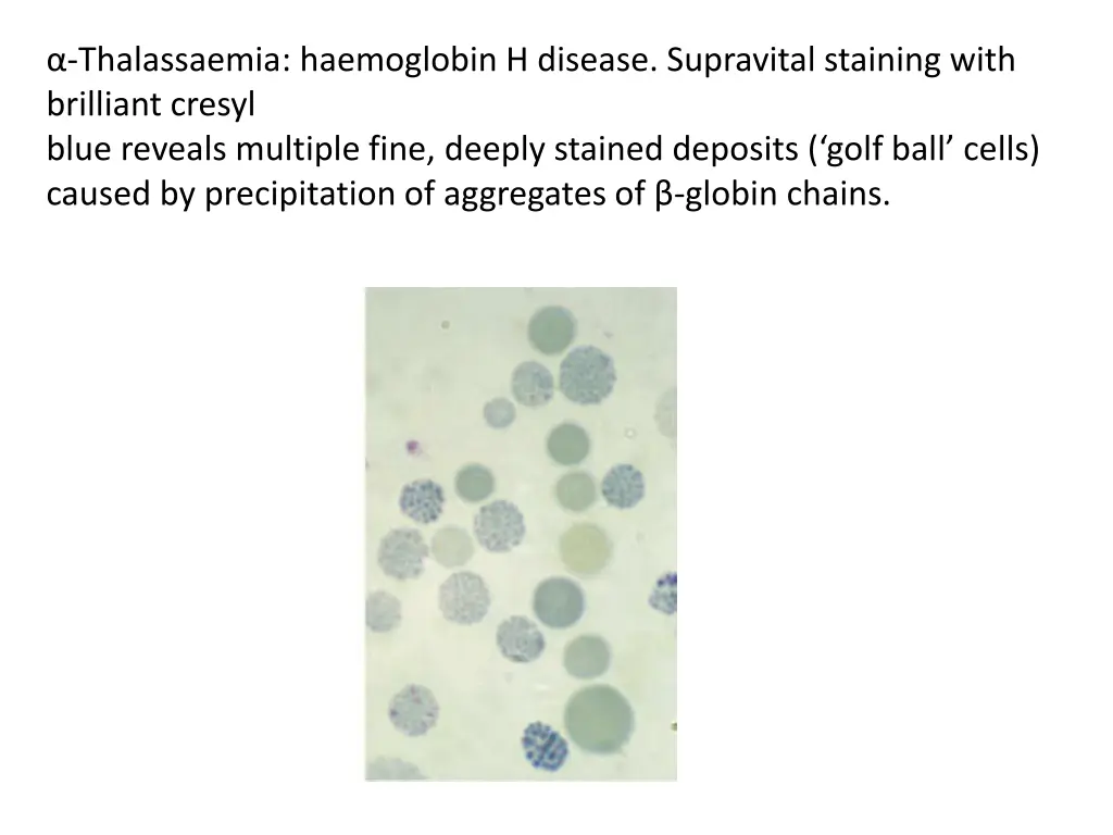 thalassaemia haemoglobin h disease supravital