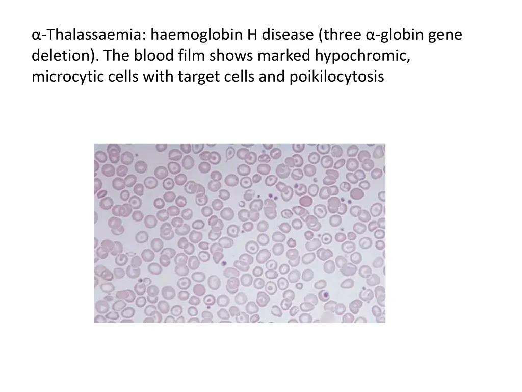 thalassaemia haemoglobin h disease three globin