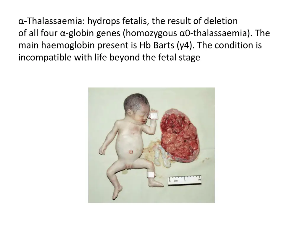 thalassaemia hydrops fetalis the result