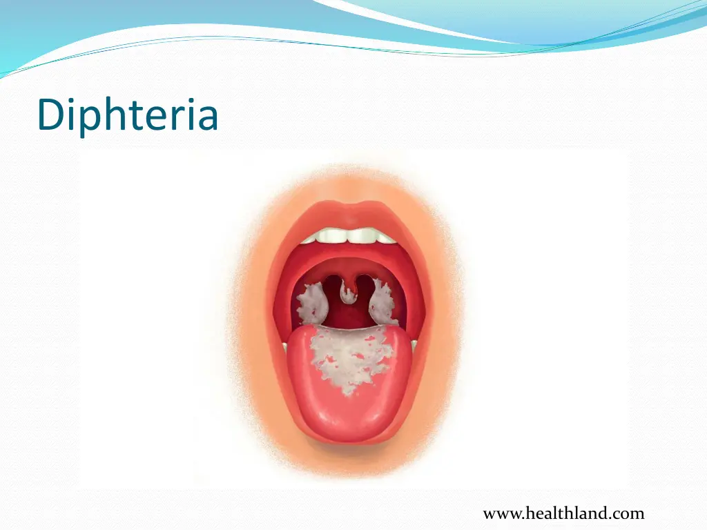 diphteria