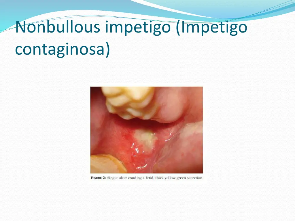 nonbullous impetigo impetigo contaginosa 1