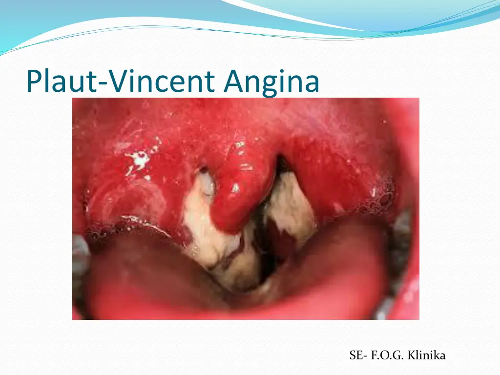 plaut vincent angina 1