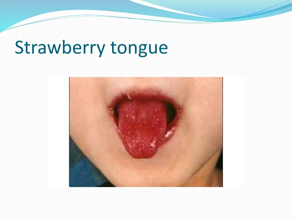 strawberry tongue