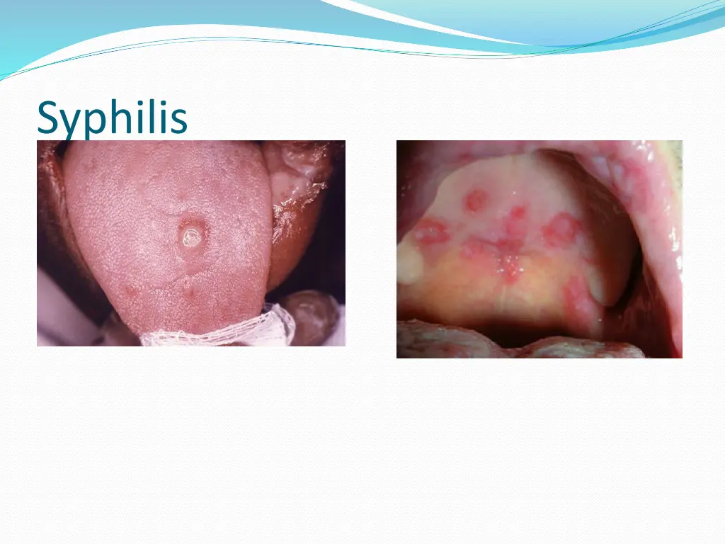 syphilis 1
