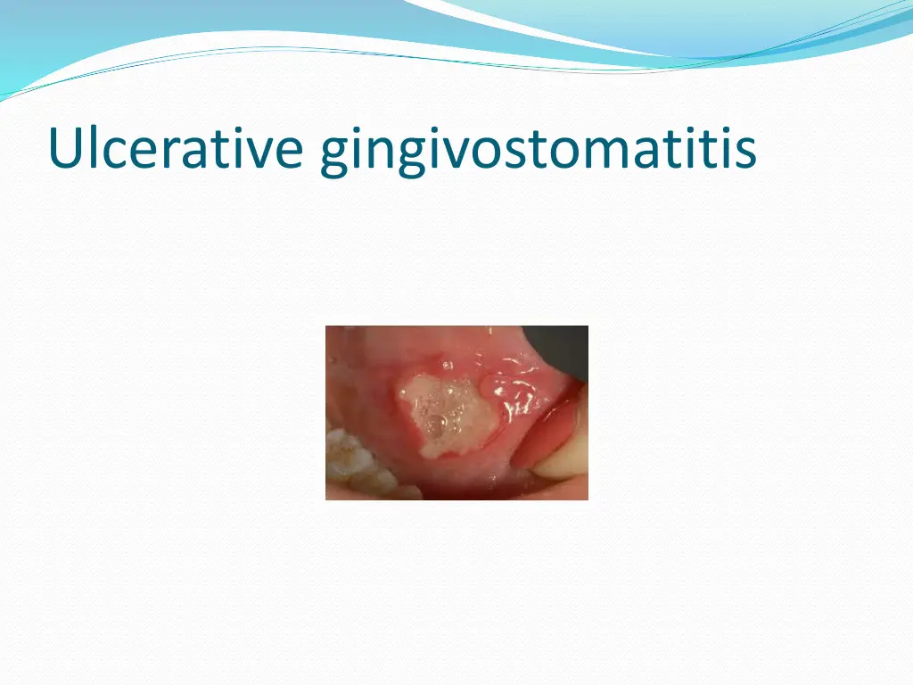 ulcerative gingivostomatitis