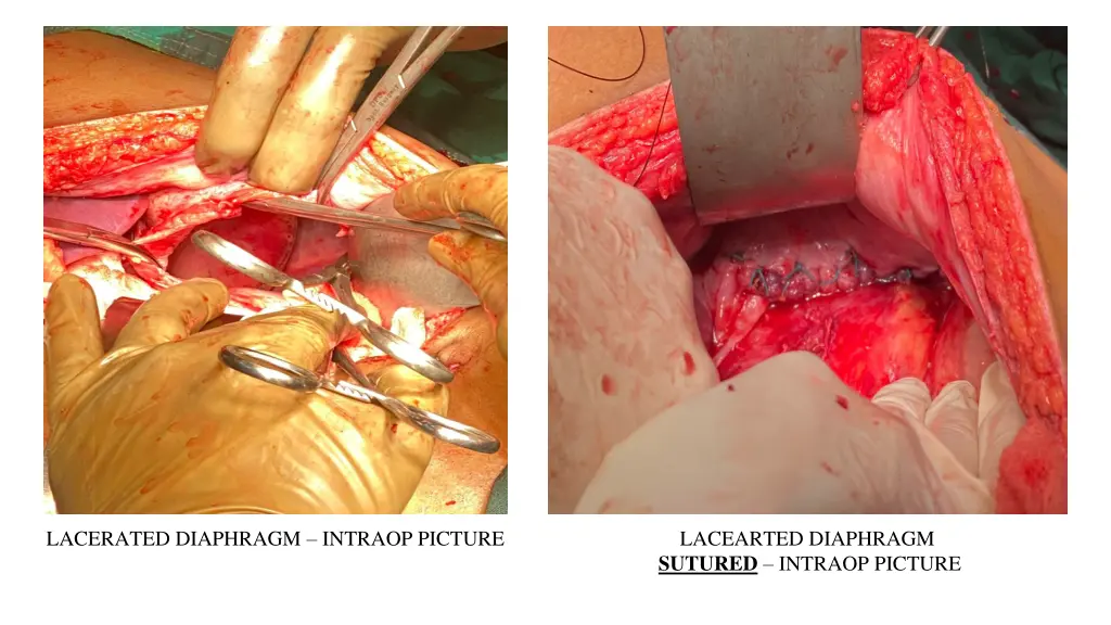 lacerated diaphragm intraop picture