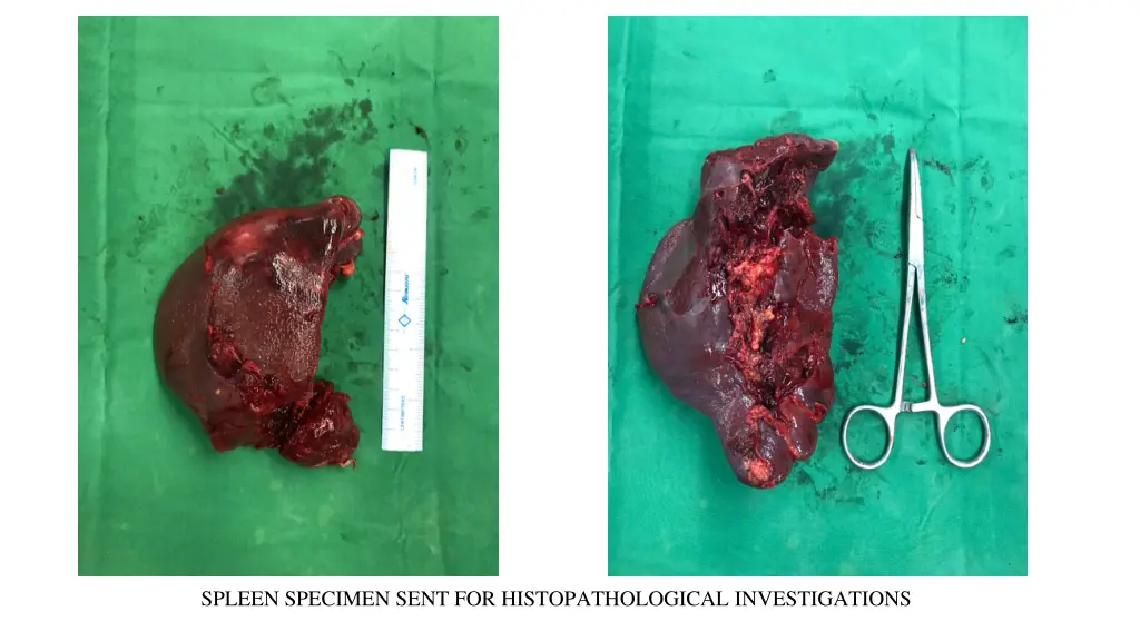 spleen specimen sent for histopathological