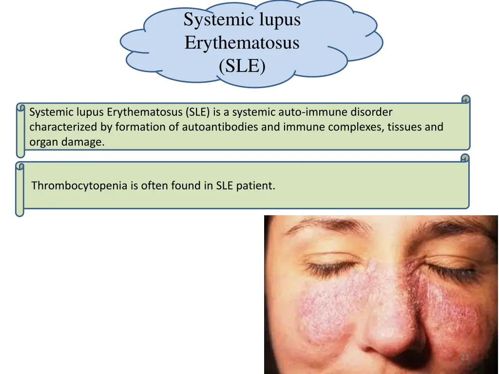systemic lupus erythematosus sle