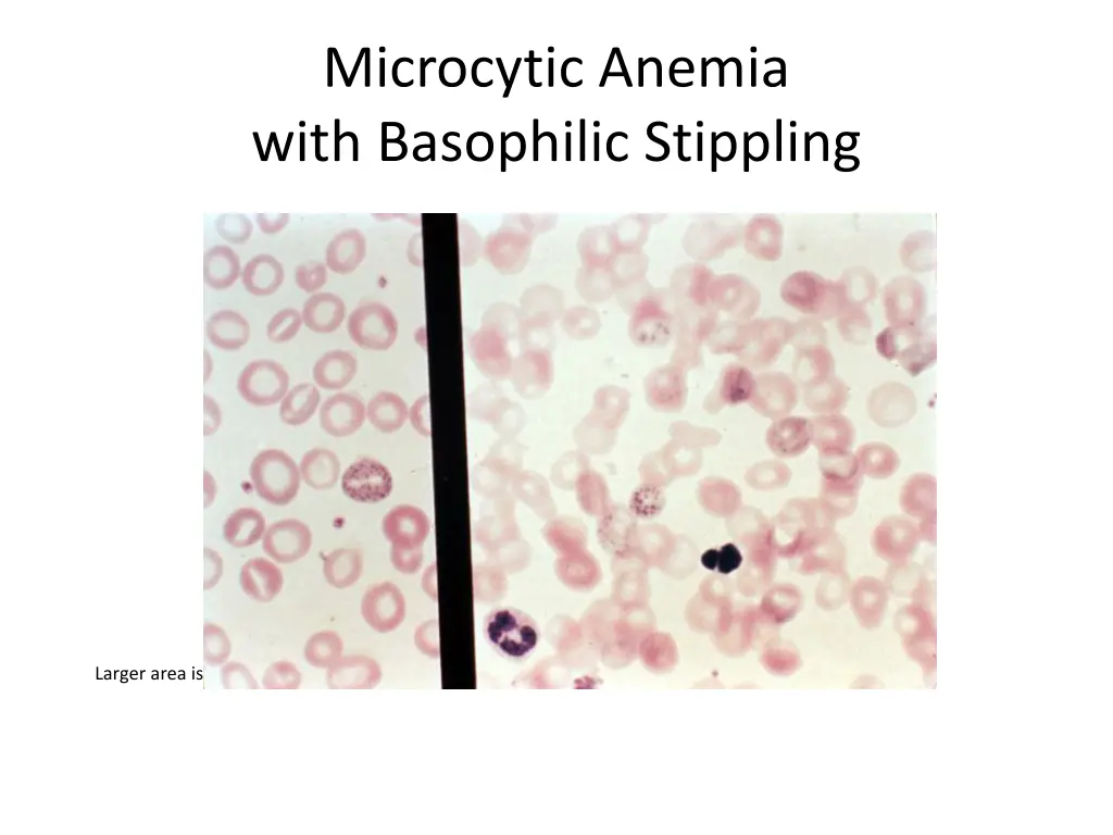 microcytic anemia with basophilic stippling