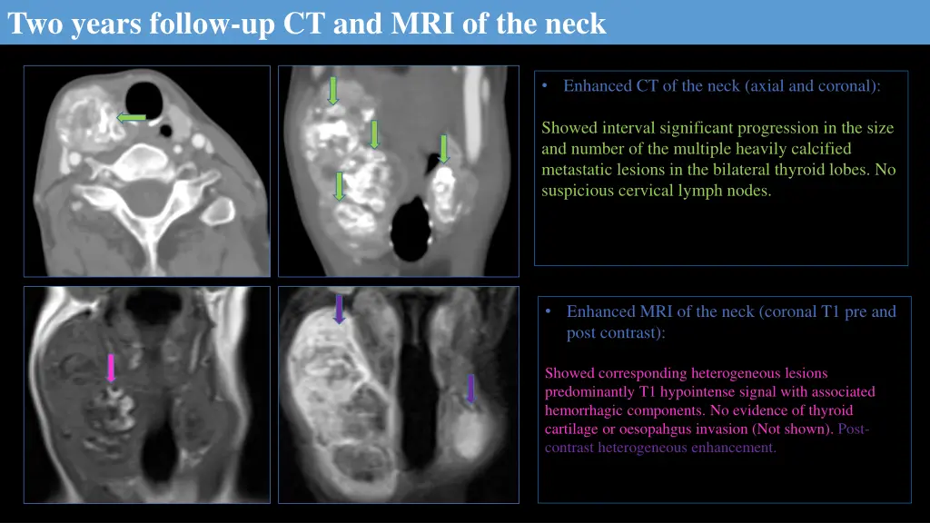 two years follow up ct and mri of the neck
