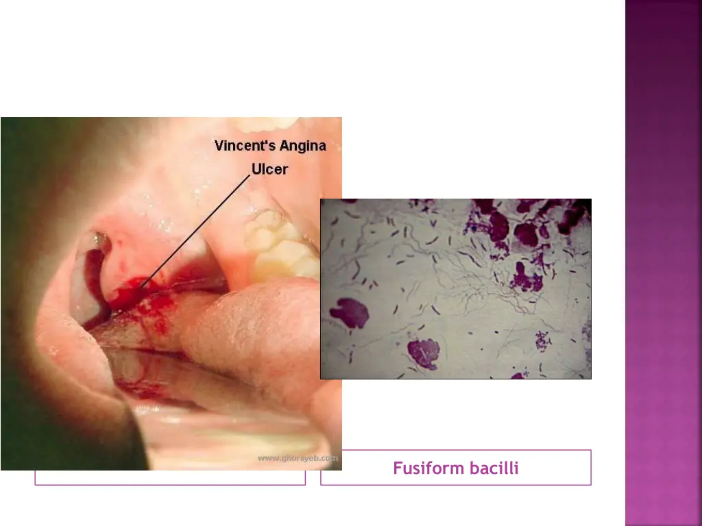 fusiform bacilli