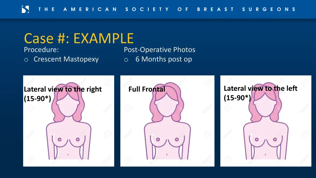 case example procedure o crescent mastopexy 1