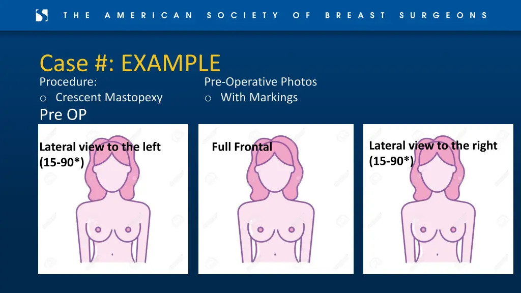 case example procedure o crescent mastopexy