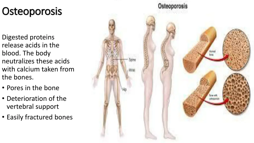 osteoporosis osteoporosis