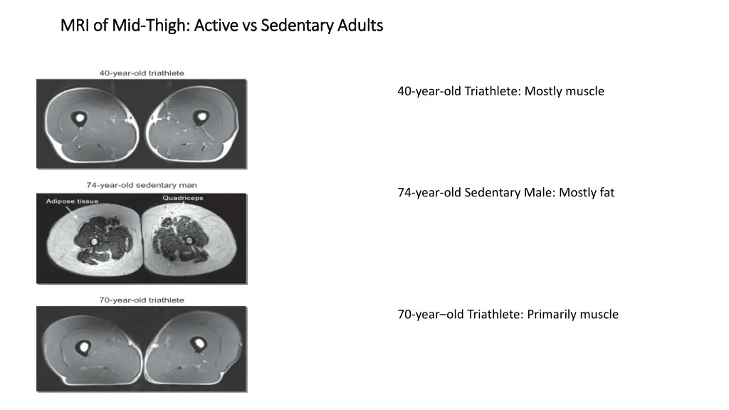 mri of mid mri of mid thigh active vs sedentary