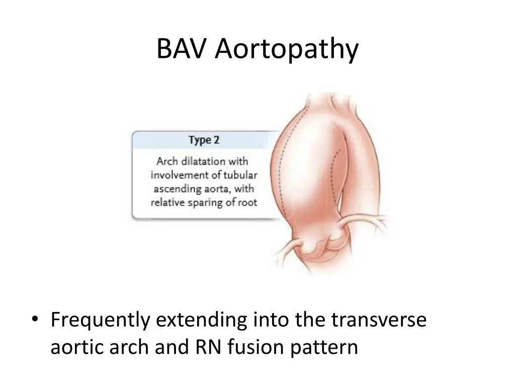 bav aortopathy 1