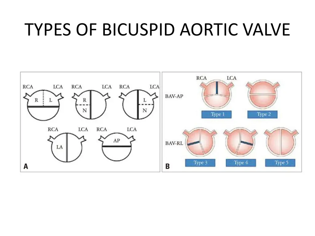 types of bicuspid aortic valve