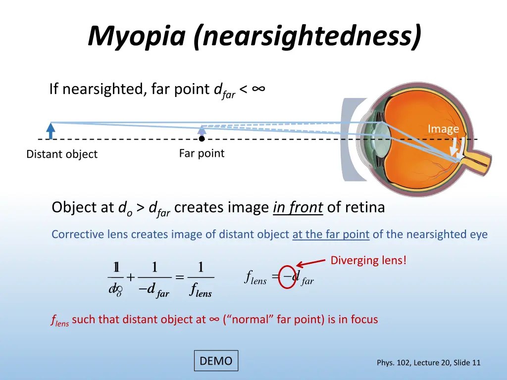 myopia nearsightedness