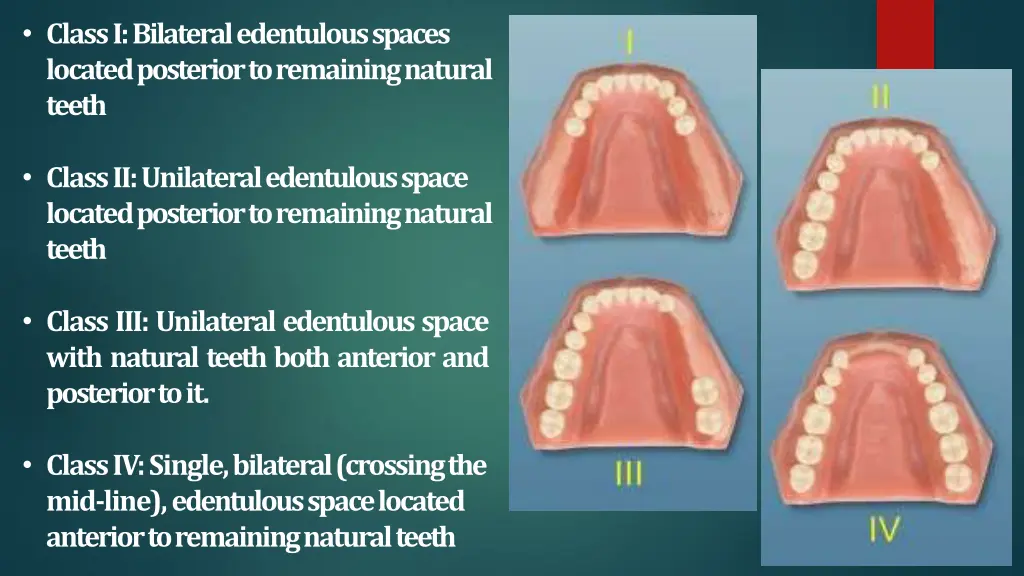 class i bilateral edentulous spaces located