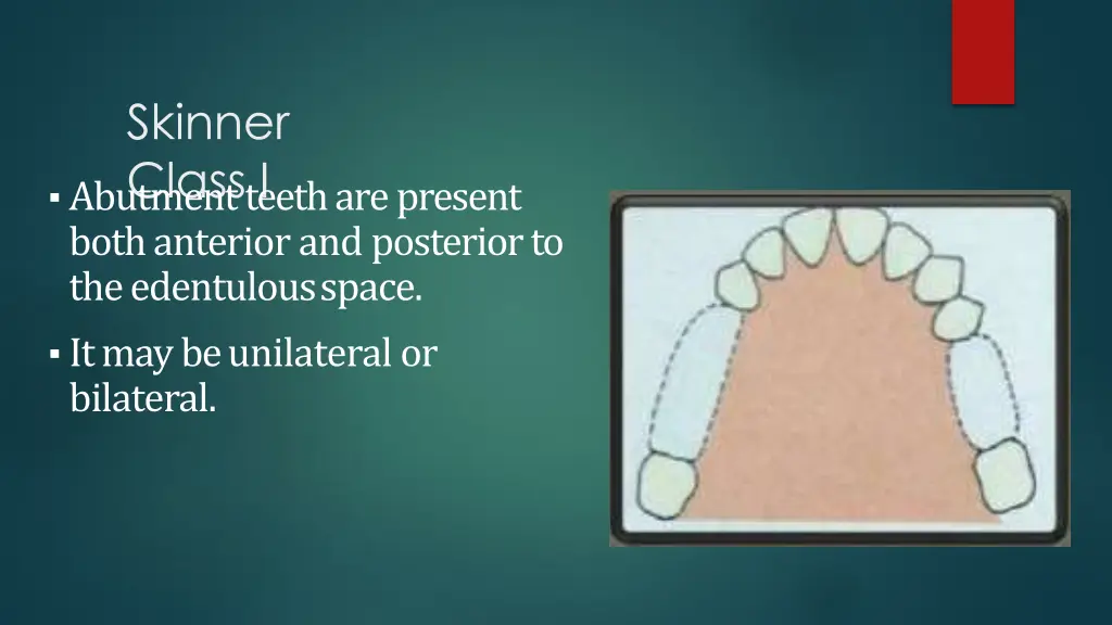 skinner class i abutment teeth are present both