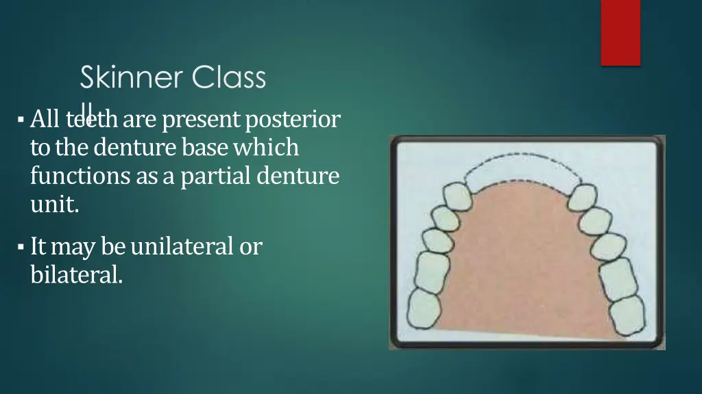 skinner class ii all teeth are present posterior