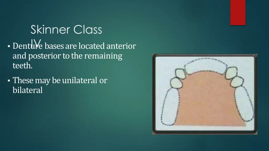 skinner class iv denture bases are located
