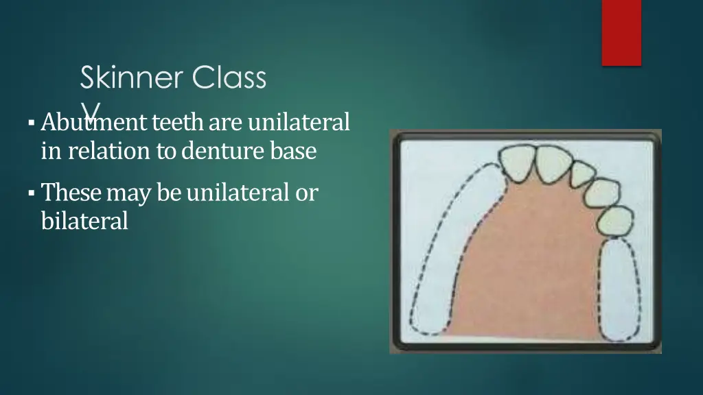 skinner class v abutment teeth are unilateral