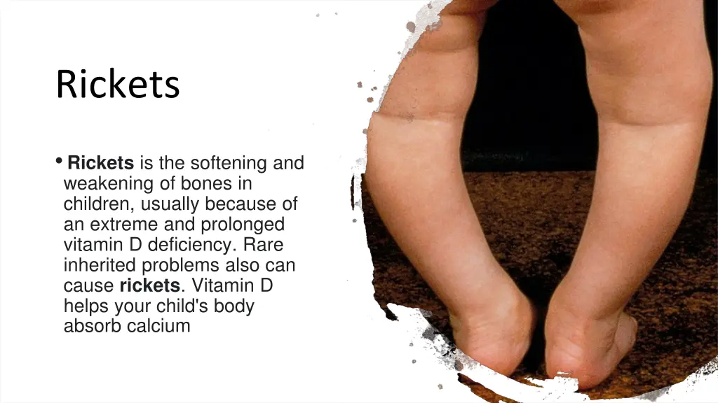 rickets