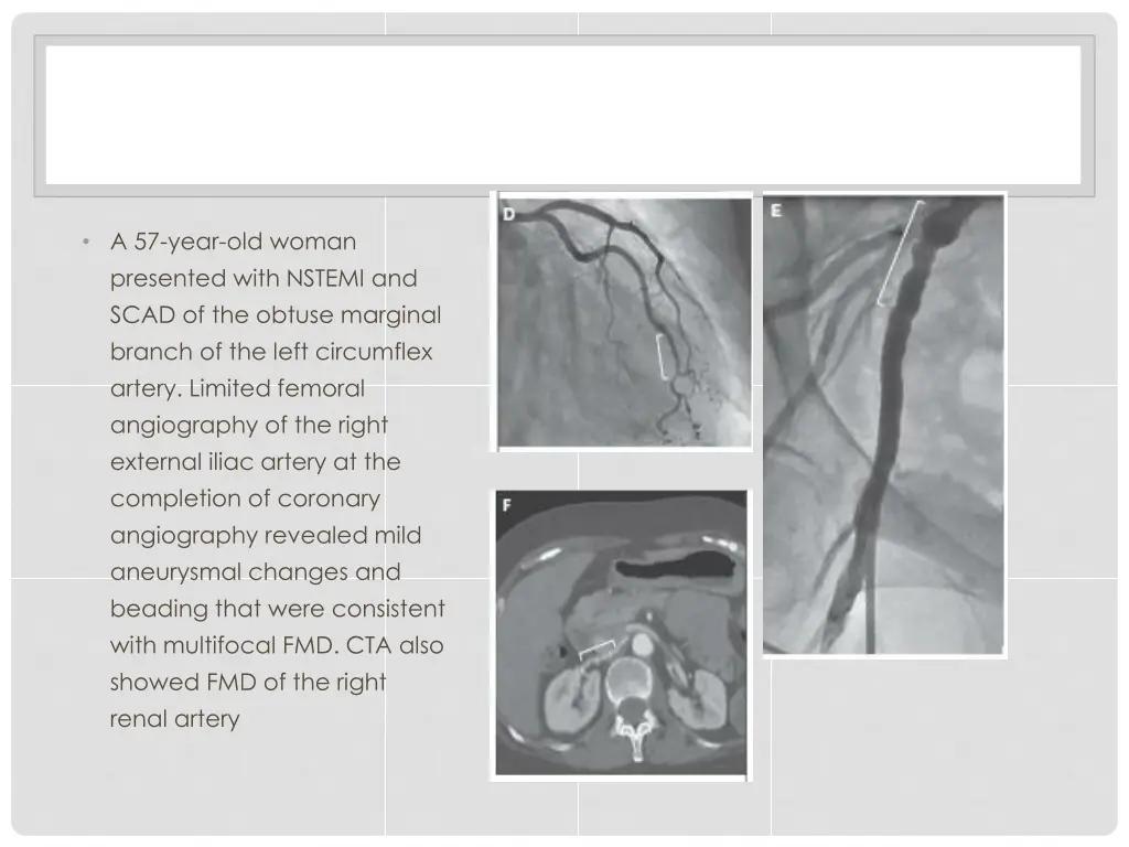 a 57 year old woman presented with nstemi