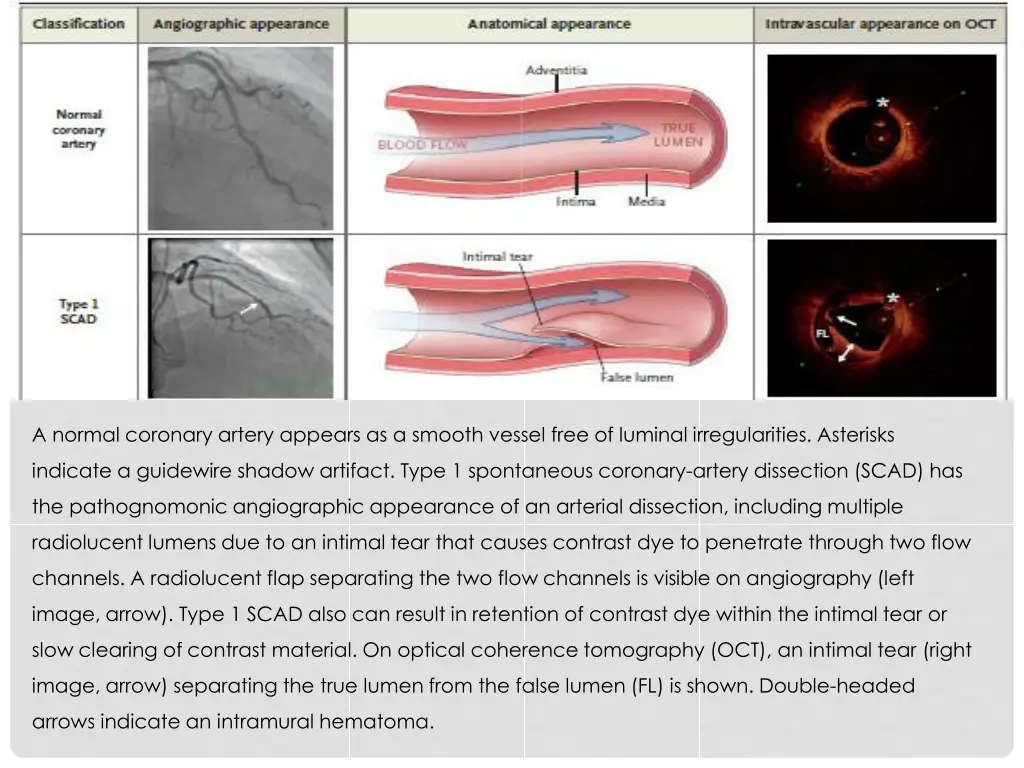 a normal coronary artery appears as a smooth