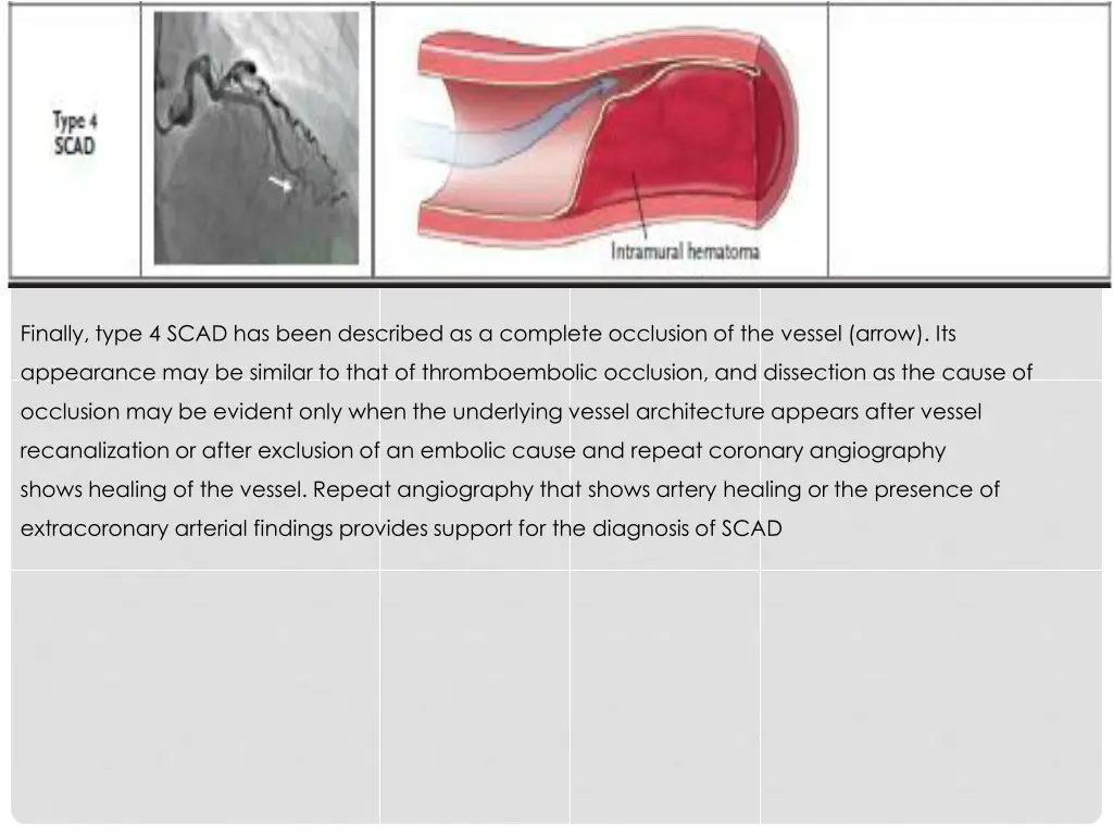 finally type 4 scad has been described