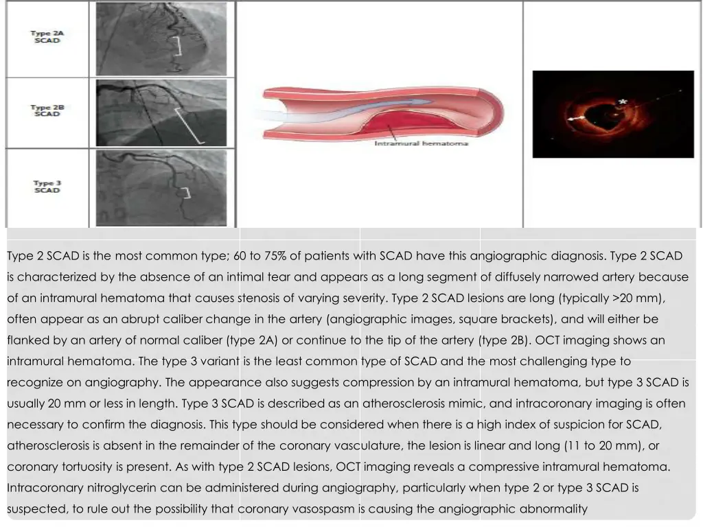 type 2 scad is the most common type