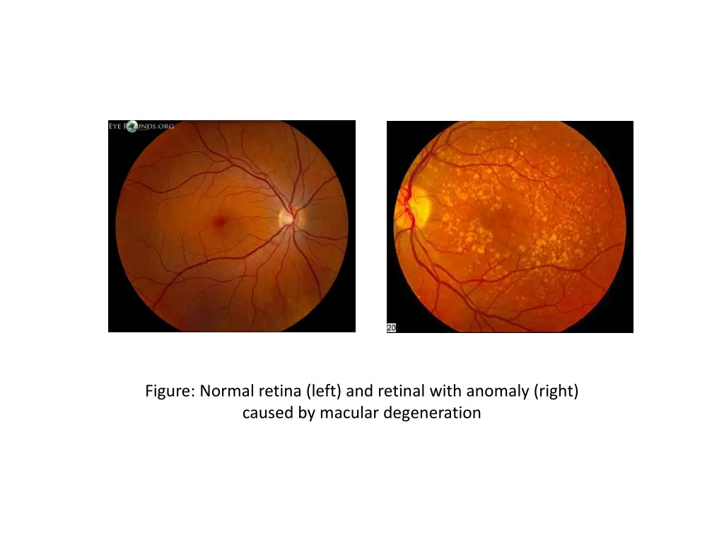 figure normal retina left and retinal with