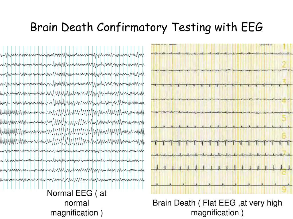 brain death confirmatory testing with eeg