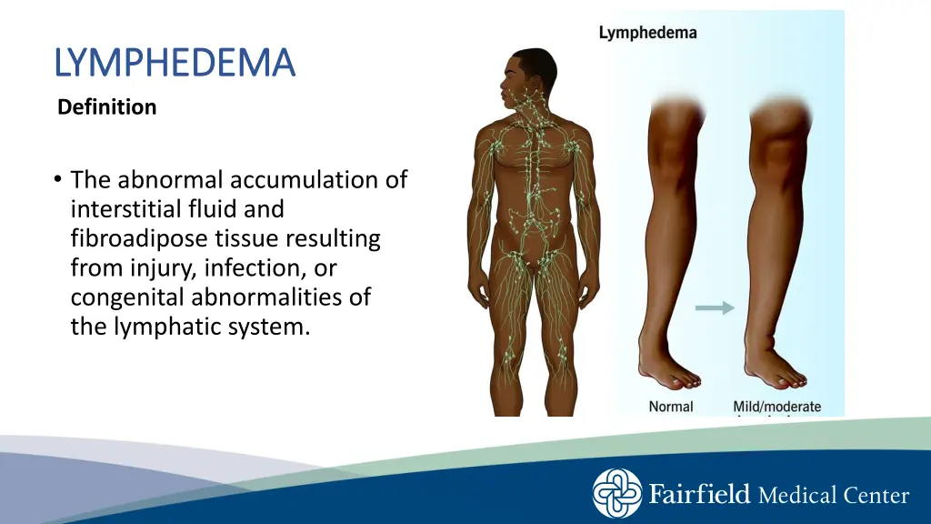 lymphedema lymphedema