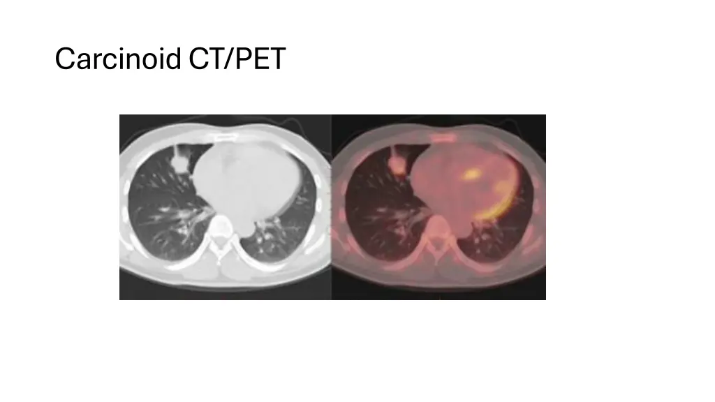 carcinoid ct pet