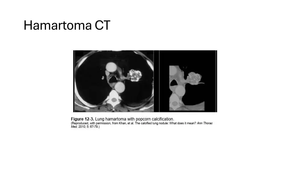 hamartoma ct