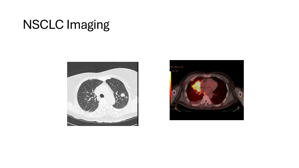 nsclc imaging