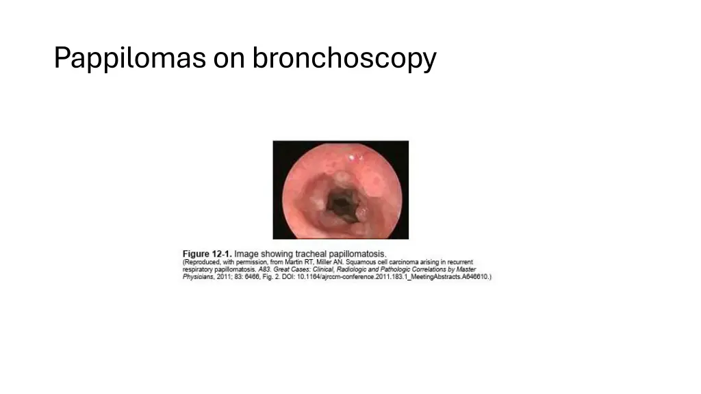 pappilomason bronchoscopy