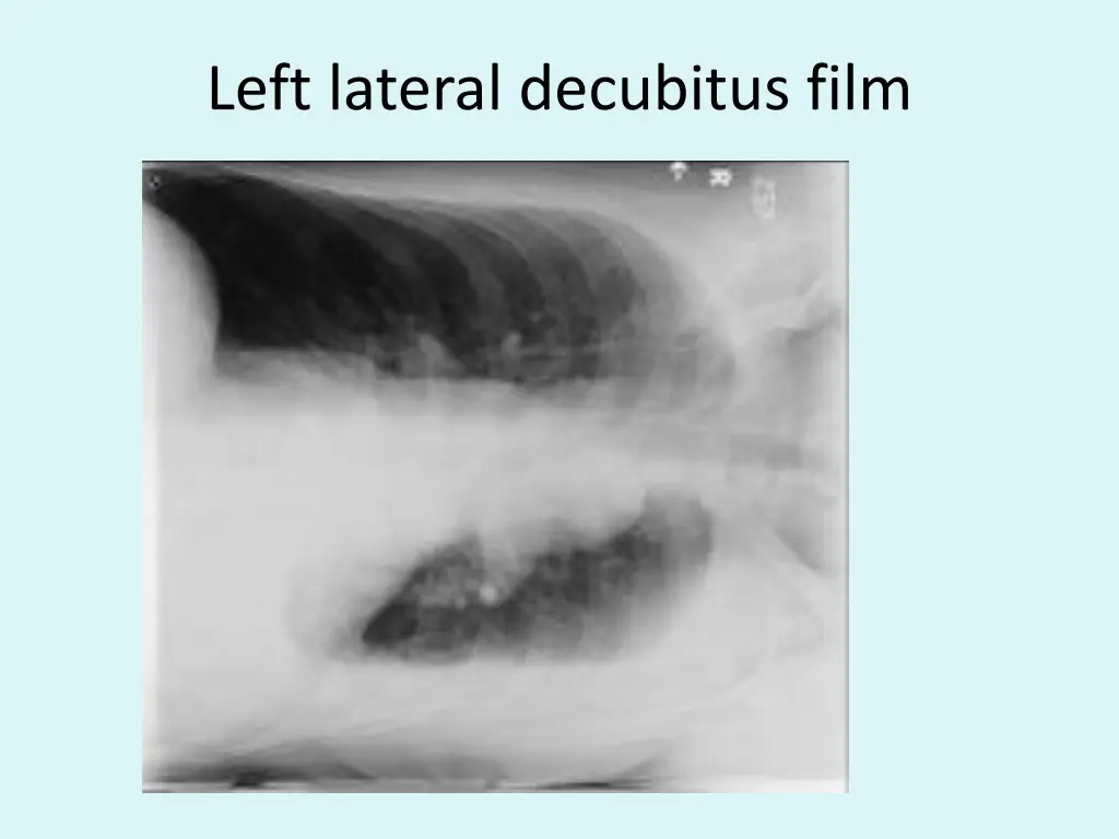 left lateral decubitus film