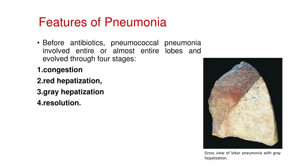 features of pneumonia