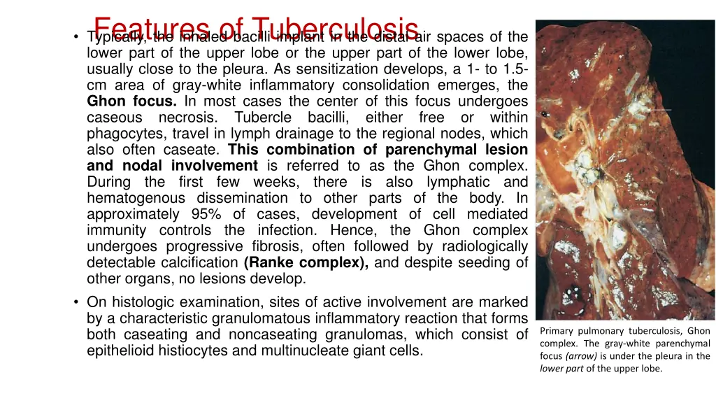 features of tuberculosis typically the inhaled