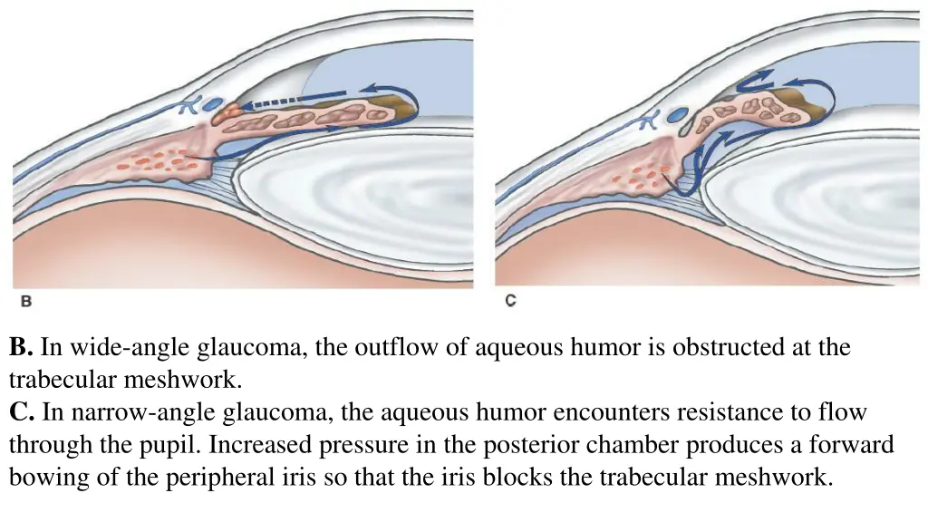 b in wide angle glaucoma the outflow of aqueous