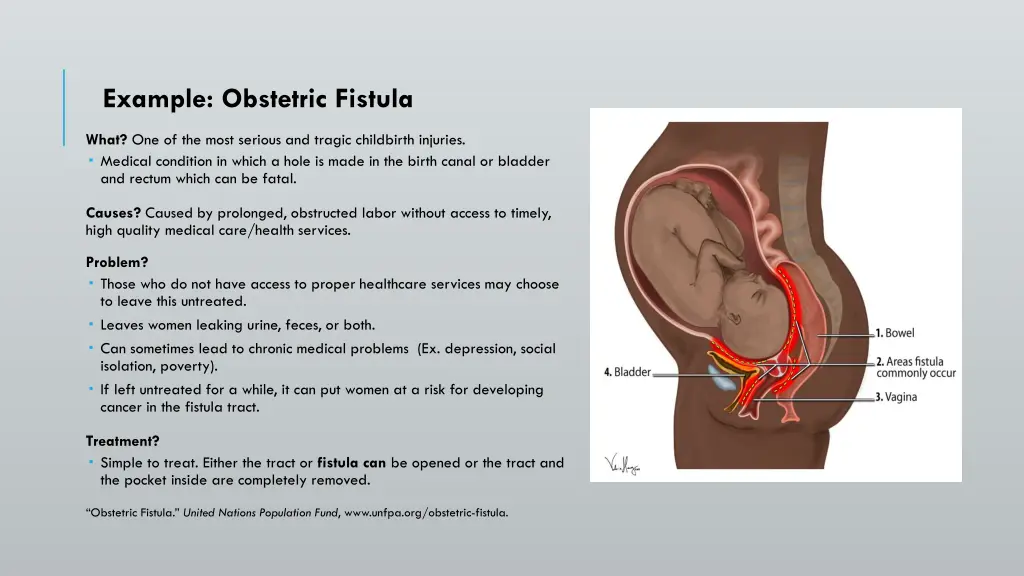 example obstetric fistula