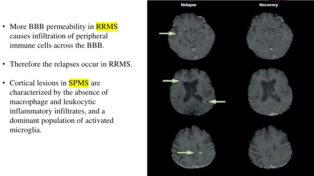 more bbb permeability in rrms causes infiltration