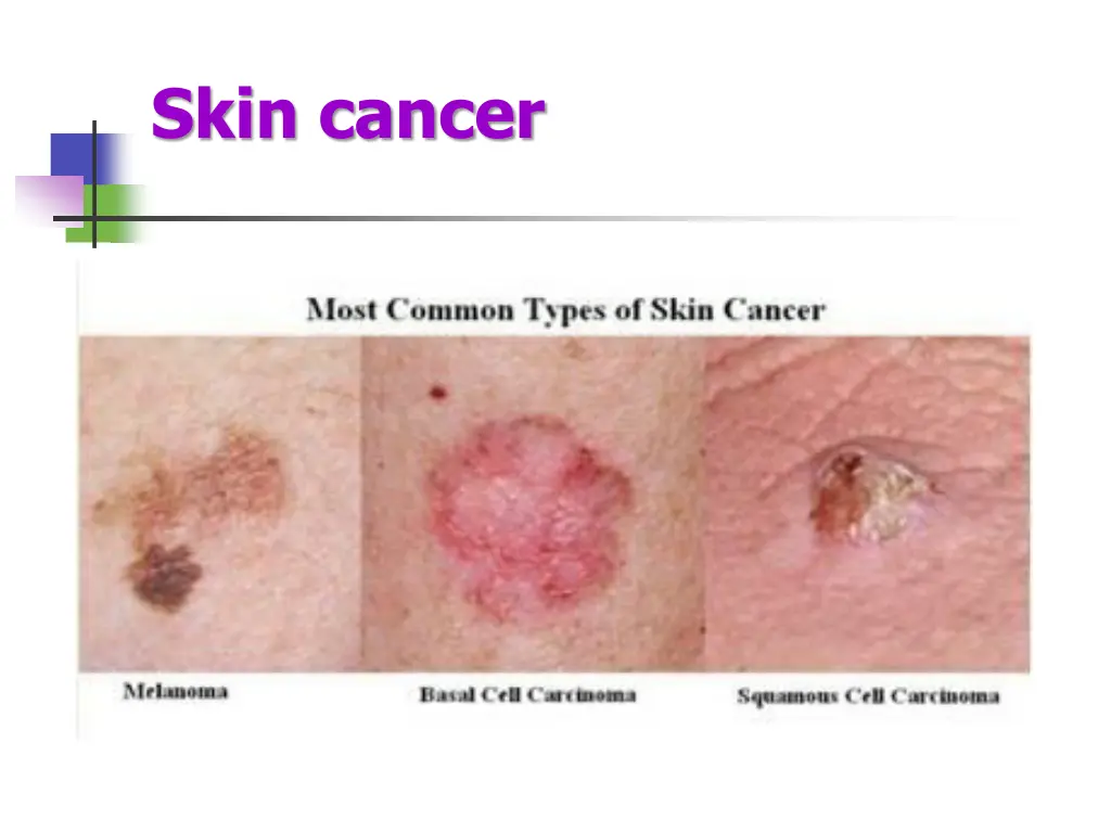 skin cancer