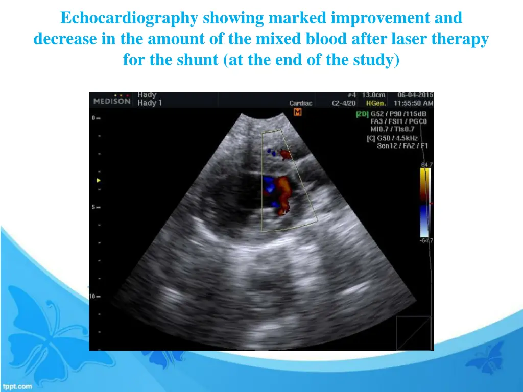 echocardiography showing marked improvement