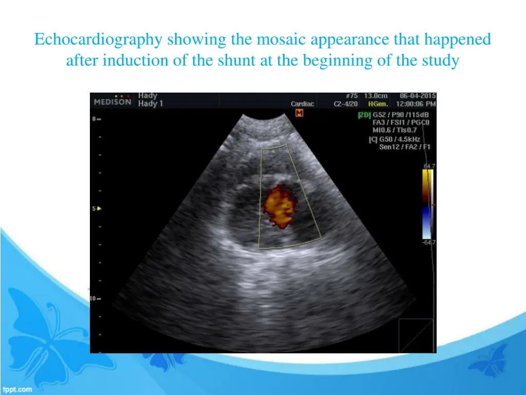 echocardiography showing the mosaic appearance