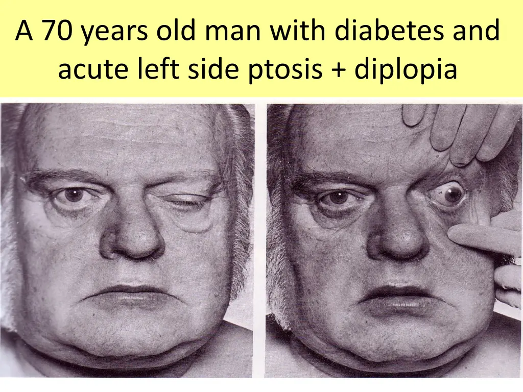 a 70 years old man with diabetes and acute left