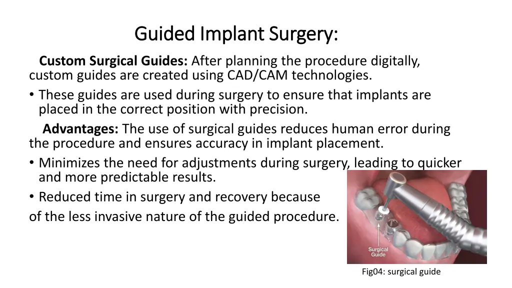 guided guided implant implant surgery